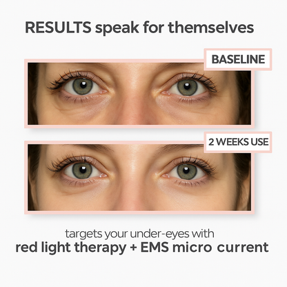 LumaEye Under Eye Rejuvenation